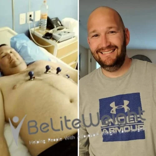 Weight Loss Surgery Before And After